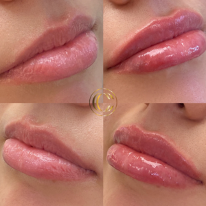 cosmetic clinic -lipsr image 1(4)