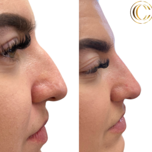 cosmetic clinic -non - surgical nose job 1