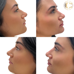 cosmetic clinic -non - surgical nose job 10