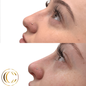 Non-Surgical Nose Job | LIQUID RHINOPLASTY | Cosmetic Clinic