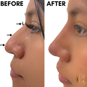 cosmetic clinic -non - surgical nose job 13
