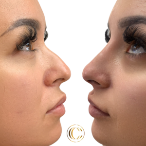 cosmetic clinic -non - surgical nose job 3