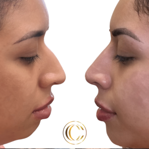 cosmetic clinic -non - surgical nose job 8