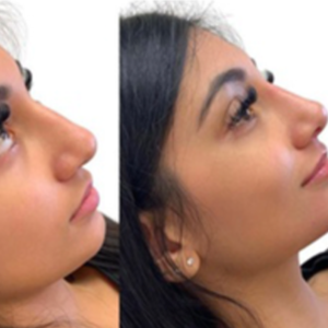 Non-Surgical Nose Job | Liquid rhinoplasty | Cosmetic Clinic